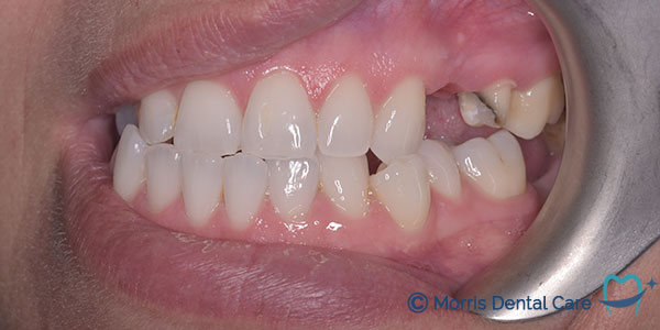 Before treatment the patient had worn teeth with some gapping